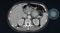 Axial body CT showing a target tumor lesion with AI assisted followup measurement overlay
