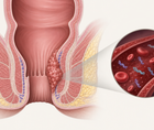 tumor informed ctdna stratifies risk in anal squamous cell carcinoma