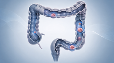 ai assisted colorectal lesion detection falls short in private practice trial