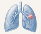 oncologist preferences in first line alk positive metastatic nsclc