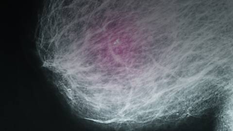 Breast Basics 101: What Every Woman Should Know About Breast Cancer Risk, Screening, & Detection