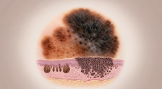 Dermoscopic melanoma lesion with residual nevus component and layered skin architecture