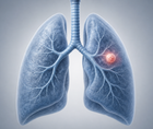 real world first line alk tki comparisons in alk positive nsclc