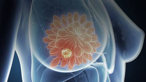 Catching Up on Current & Future Breast Cancer Clinical Trials