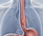 robot assisted versus conventional minimally invasive oesophagectomy