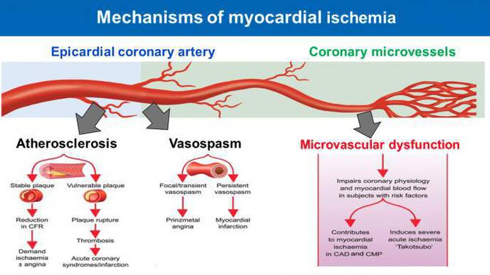Important Global Health Problem Identified: Disease of the Smallest Heart Blood Vessels