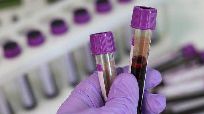 Using Blood Samples to Predict Immunotherapy Response in Metastatic NSCLC