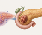 pancreatic ductal adenocarcinoma with autoimmune pancreatitis