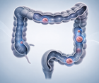 ai assisted colorectal lesion detection falls short in private practice trial