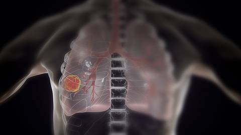 Comparing Combination Therapies for Lung Cancer: Rationales & Risks