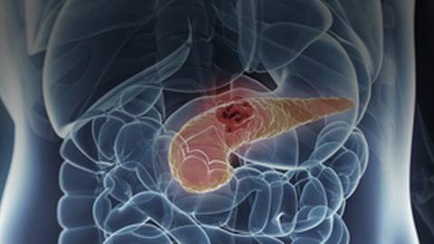 Pancreatic Cancer: The Hunt to Catch a Silent Killer