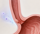 zanidatamab regimens vs trastuzumab in her2 positive gea