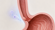 zanidatamab regimens vs trastuzumab in her2 positive gea