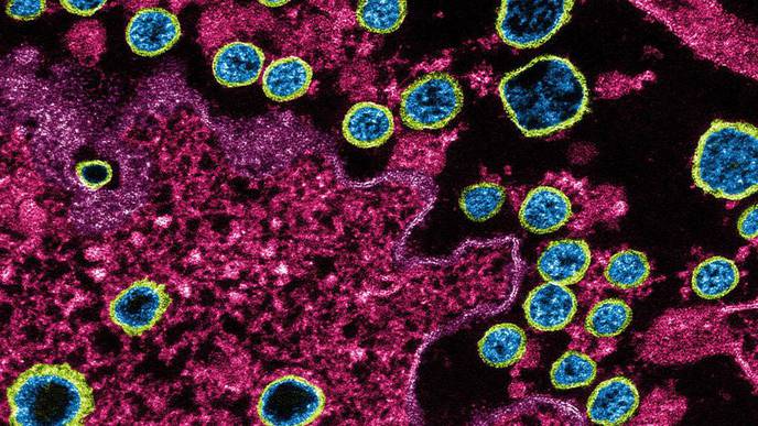 Genes May Leave Some People More Vulnerable to Severe COVID-19