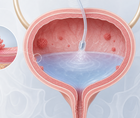 phase 2 core 008 readout of cretostimogene plus gemcitabine in nmibc
