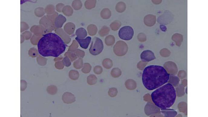 Blood Cancer Discovery Raises New Treatment Hopes