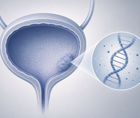 urine tumor dna stratifies recurrence risk during bcg in high risk nmibc