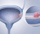 bcg plus mitomycin fails to improve dfs in anzup 1301