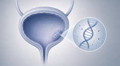 urine tumor dna stratifies recurrence risk during bcg in high risk nmibc