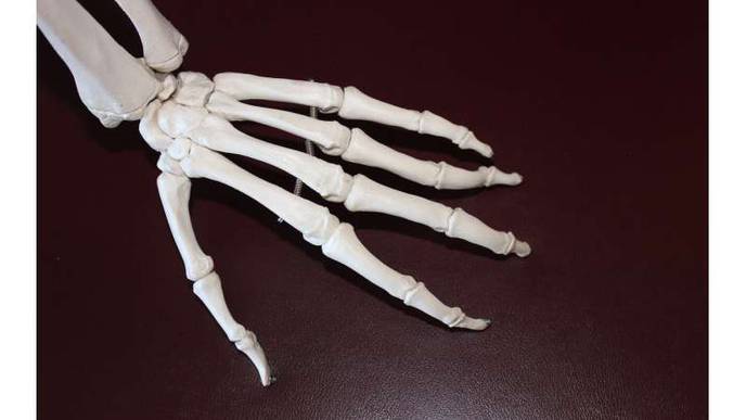 FDA Approves New Wrist Replacement Device to Relieve Arthritis Pain