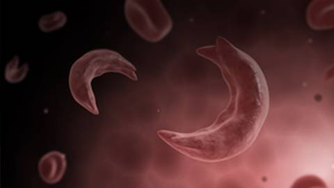 Beyond the Data: Improving the Lives of People with Sickle Cell Disease