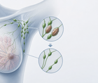 surgical outcomes after neoadjuvant pembrolizumab in keynote 522