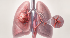 Bulky non small cell lung cancer in the lung with locoregional embolization concept
