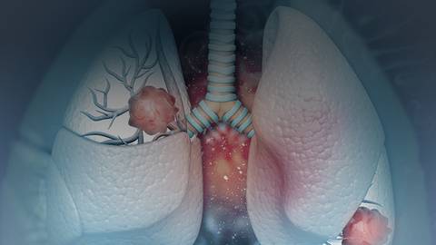 Keeping Pace in Lung Cancer: Clinical Case Challenges in NSCLC