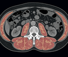 Abdominal CT slice showing low skeletal muscle mass and density in a cancer patient