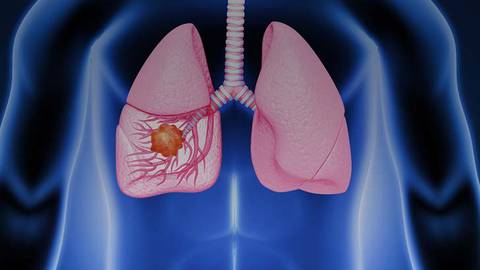 Lung Cancer Screening and Treatment of Early Stage