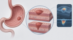 Simplified stomach illustrating AI assessment of mucosal versus submucosal early gastric cancer