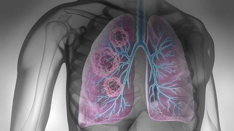 Understanding Updates in Lung Cancer Screening