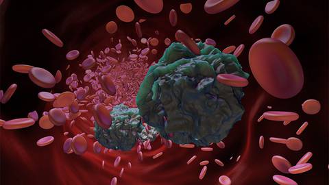 Treatment of CLL/SLL with BTKis: Whole Patient Approaches