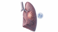 FGFR1 Gain Linked to Shorter PFS in Advanced LUSC