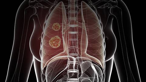 Emerging Technologies for Treating Non-Small Cell Lung Cancer