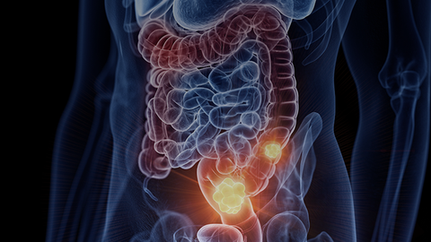 What Are the Clinical Features of HER2 Amplified Colorectal Cancers?