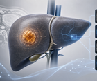 mri radiomics score and adc improve hcc recurrence prediction
