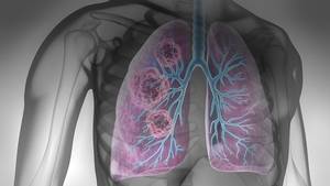 Evaluating Biomarkers at Work in NSCLC