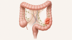 Colorectal cancer anatomy with highlighted regional lymph nodes suggesting metastasis risk