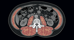 Abdominal CT slice showing low skeletal muscle mass and density in a cancer patient