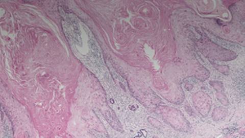 Squamous Cell Carcinoma of the Head and Neck (SCCHN): Focus on Recurrent/Metastatic Disease