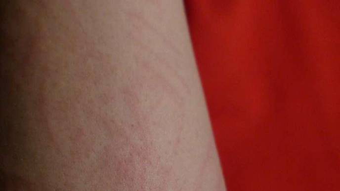 Community-Based Study Links Skin Rashes to COVID-19