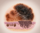 Dermoscopic melanoma lesion with residual nevus component and layered skin architecture