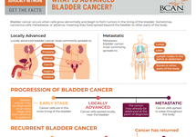Patient Resource – What Is Advanced Bladder Cancer?