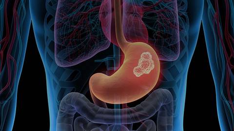 Optimal Standards of Care for Second-Line HER2-Positive Advanced Gastric and GEJ Cancers