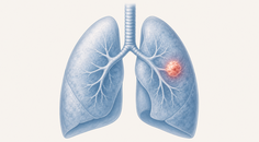 oncologist preferences in first line alk positive metastatic nsclc
