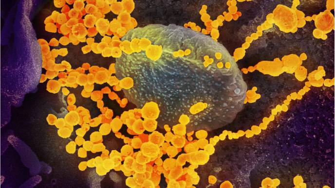 SARS-CoV-2 Found in Semen of COVID-19 Patients