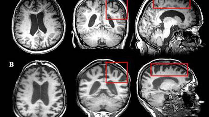 Study Looks at Neurodegeneration in MS Patients as They Age