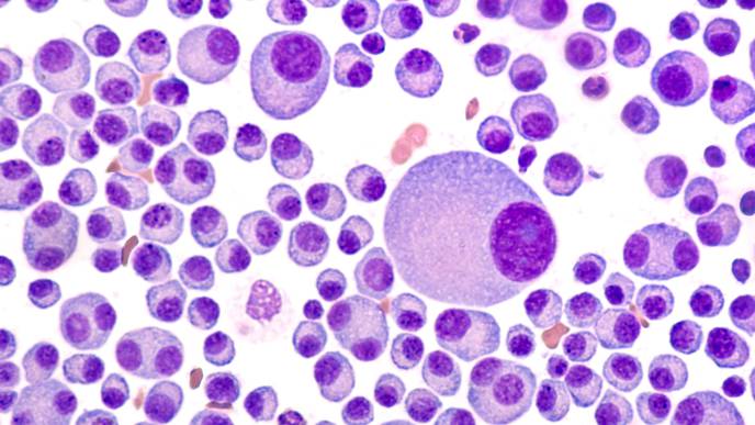 Loss of 1 Copy of a Gene Cluster May Contribute to Progression of Multiple Myeloma