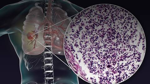 New Approaches to Treating Non-Small Cell Lung Cancer